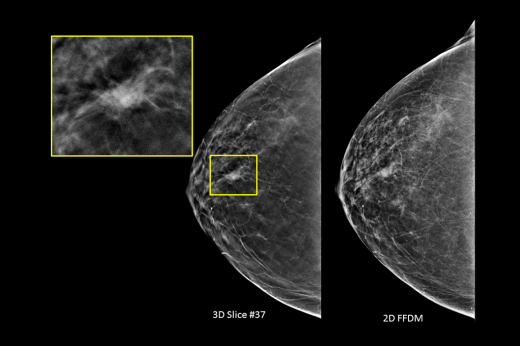 Clinical images of breast scan