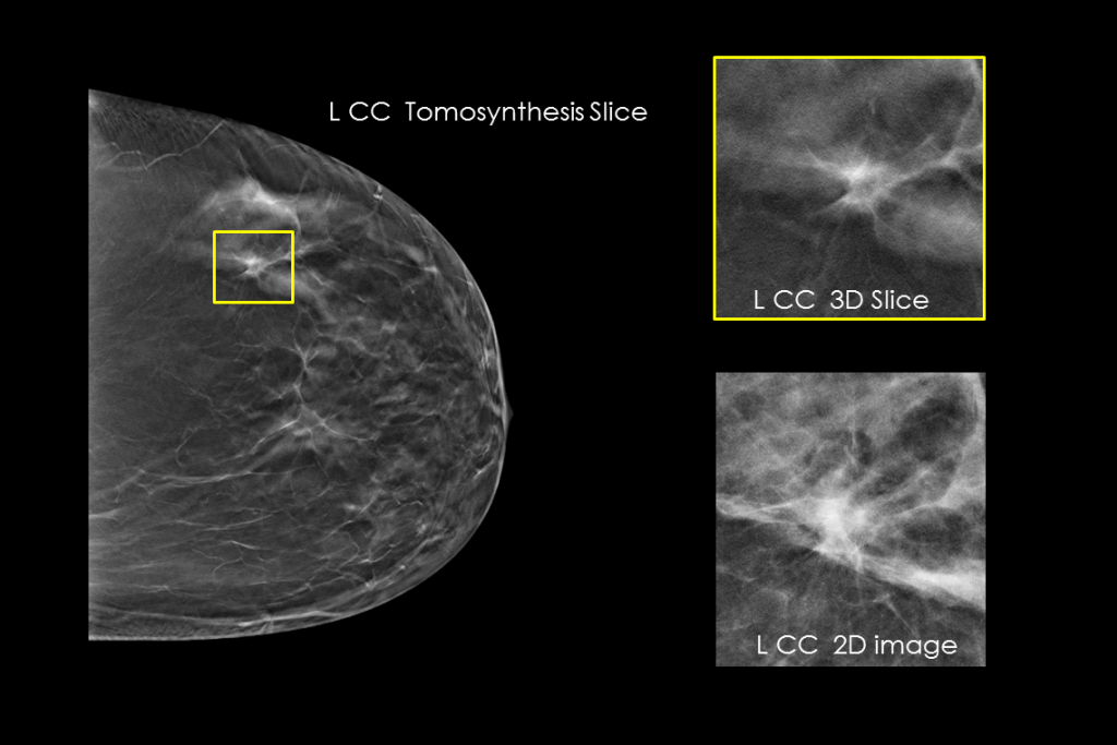 Clinical images of breast scan with fatty breast